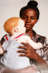 Mother_of_an_Albino_child